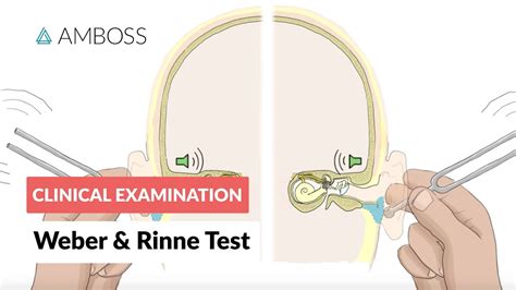 rinne test results|Rinne Test: What It Is and How It Works .